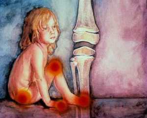 artritis reumatoide infantil